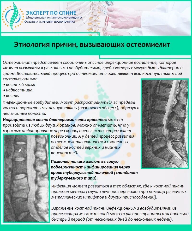 Как лечить поясничного отдела позвоночника. Остеомиелит поясничного отдела позвоночника. Остеомиелит грудного отдела позвоночника. Остеомиелит позвоночника мрт. Остеомиелит грудного отдела позвоночника кт.