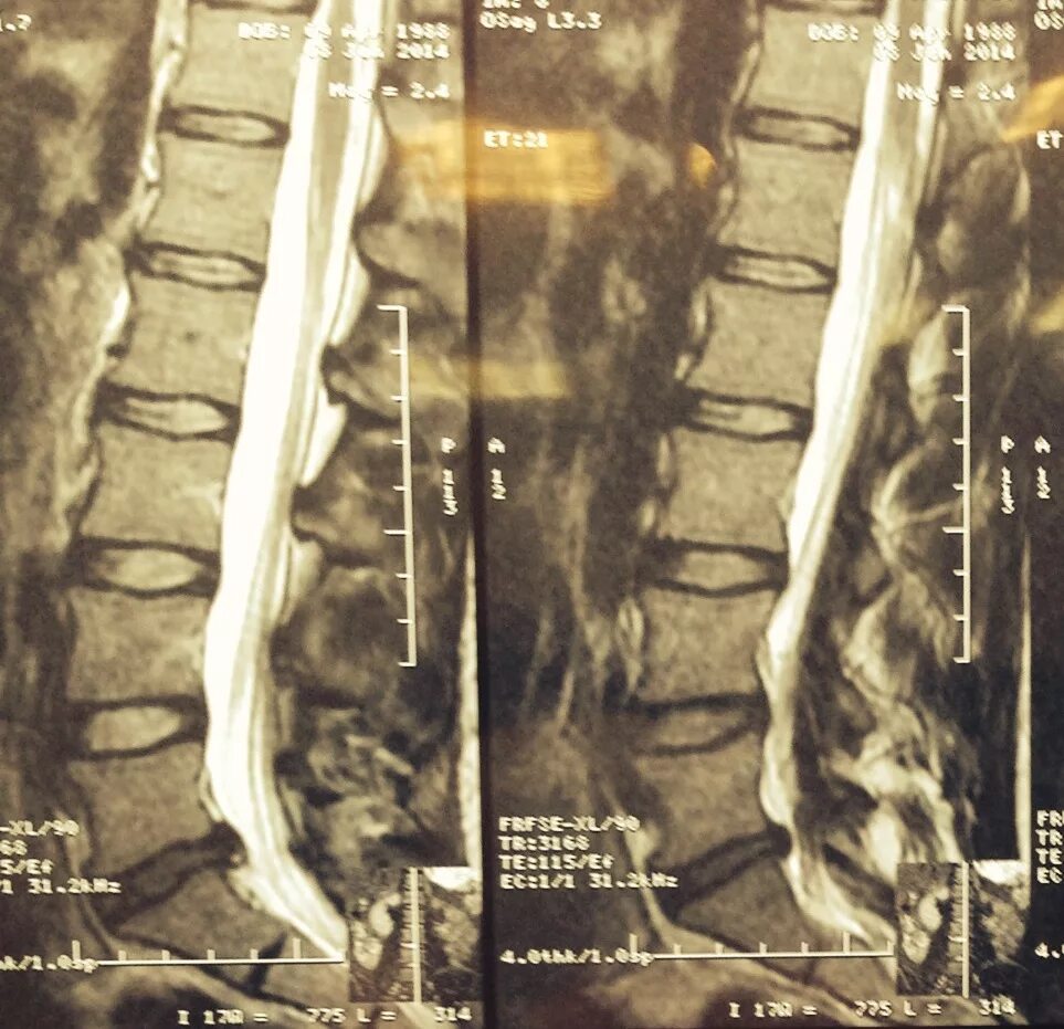 Позвоночник отдел l3 s1. Грыжа l5-s1. Грыжа l5 s1 пояснично-крестцового. Медианная грыжа позвоночника л5 с1.