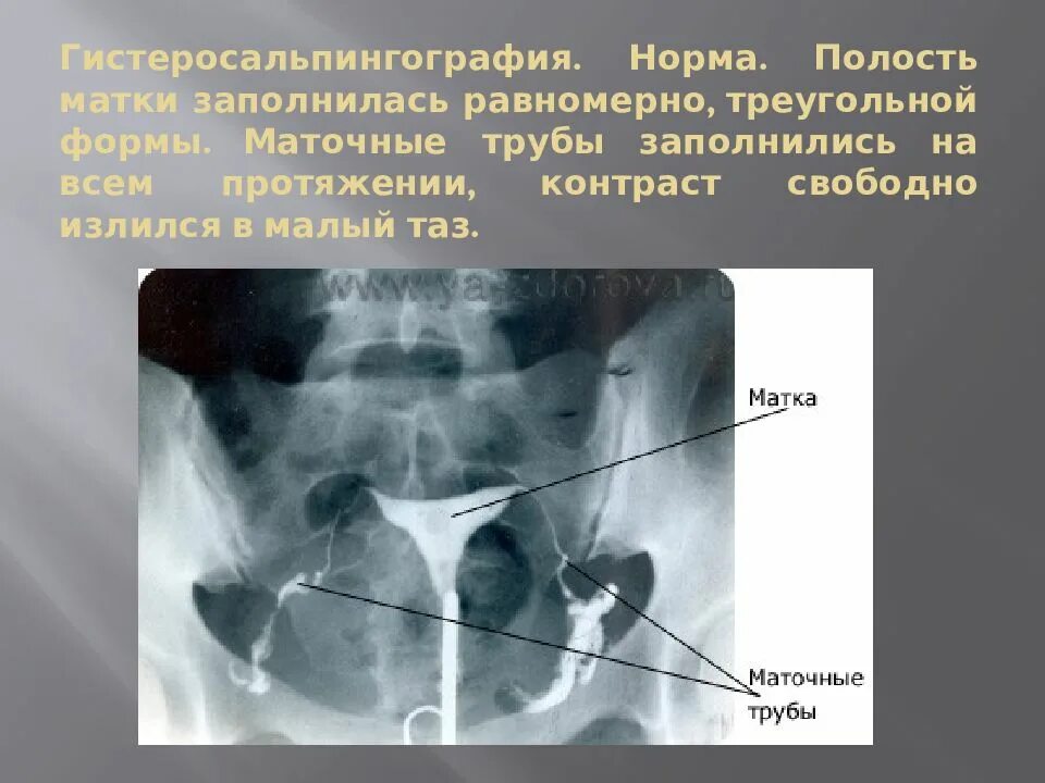 Забитые маточные трубы