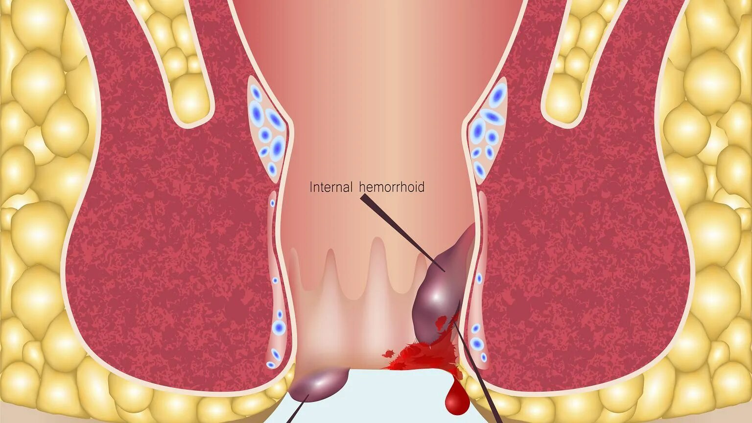 В заднем проходе шарик у женщин что. Наружный тромбированный геморрой. Воспаление геморройного узла.