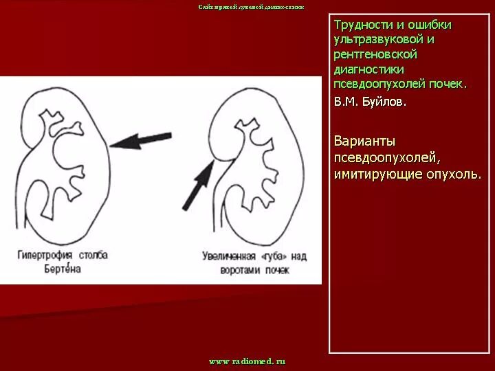 Бертиниева колонна почки. Почечные колонки Бертини. Гипертрофированная колонна Бертини почки что это. Горбатая почка