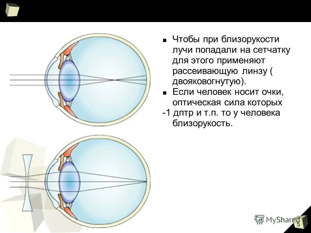 Двояковогнутые линзы при миопии. Выпуклые линзы для близоруких. Близорукость очки двояковогнутые. Рассеивающая линза для миопии.
