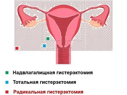 Гистерэктомия без придатков