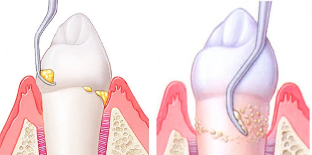Скейлинг пародонтальных карманов. Кюретаж пародонтальных карманов. Зубной камень наддесневые отложения. Поддесневой зубной камень. Как чистить десна