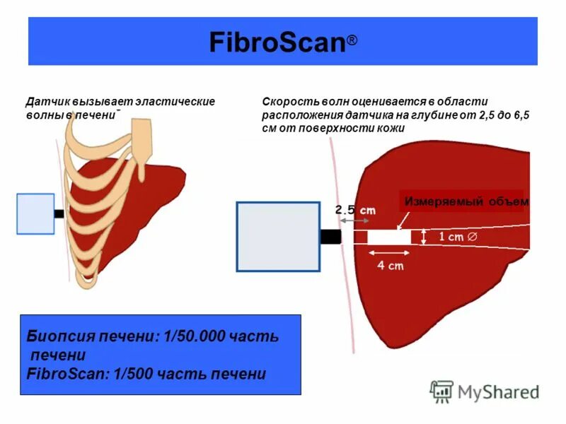 показатели фиброскана таблица. показатели фиброскана. фиброскан печени показатели. показатели фиброскана печени. эластография печени показатели.