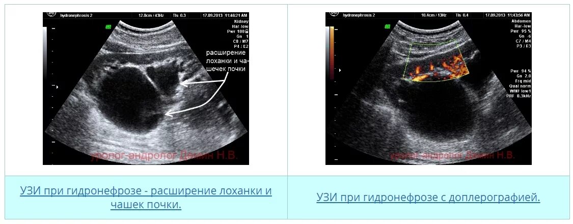 Дилатация мочеточника. Расширение почечной лоханки на УЗИ. Гидронефроз почки УЗИ. Измерение почечной лоханки на УЗИ.