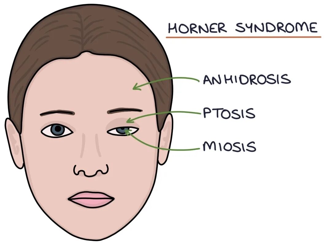 Ptosis латынь. Ptosis латынь