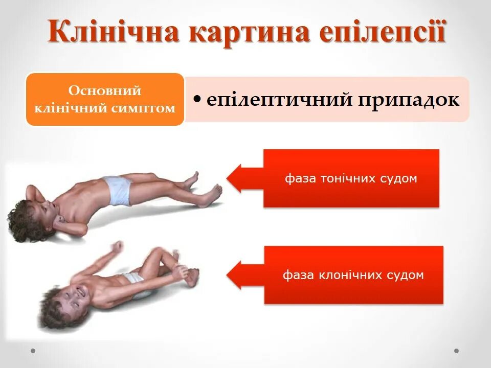 Почему случаются судороги. Эпилептический припадок. Судорожный эпилептический припадок.