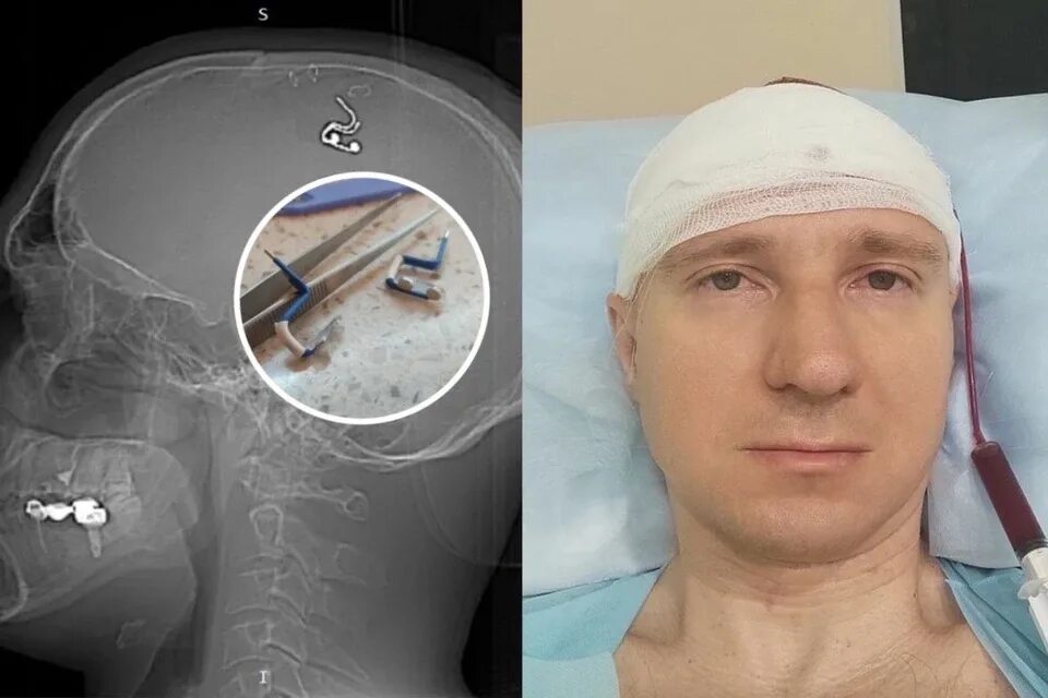 Муж случайно выстрелил в свою молодую жену и оставил ее без лица.Спустя 5 лет же