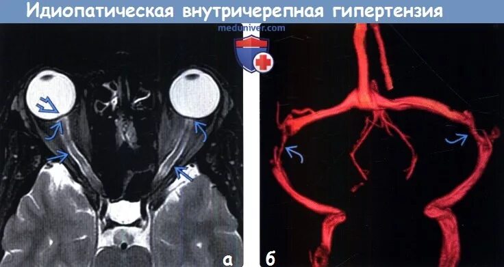 Внутричерепная гипертензия мрт кт. Доброкачественная внутричерепная гипертензия мрт. Признаки внутричерепной гипертензии на мрт. Идиопатическая внутричерепная гипертензия мрт.