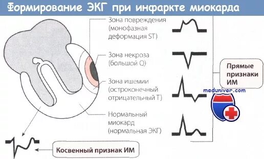 Изменения в миокарде желудочков на экг. Инфаркт миокарда на экг. экг при инфаркте миокарда. изменения на экг при инфаркте миокарда. трансмуральный инфаркт миокарда на экг.