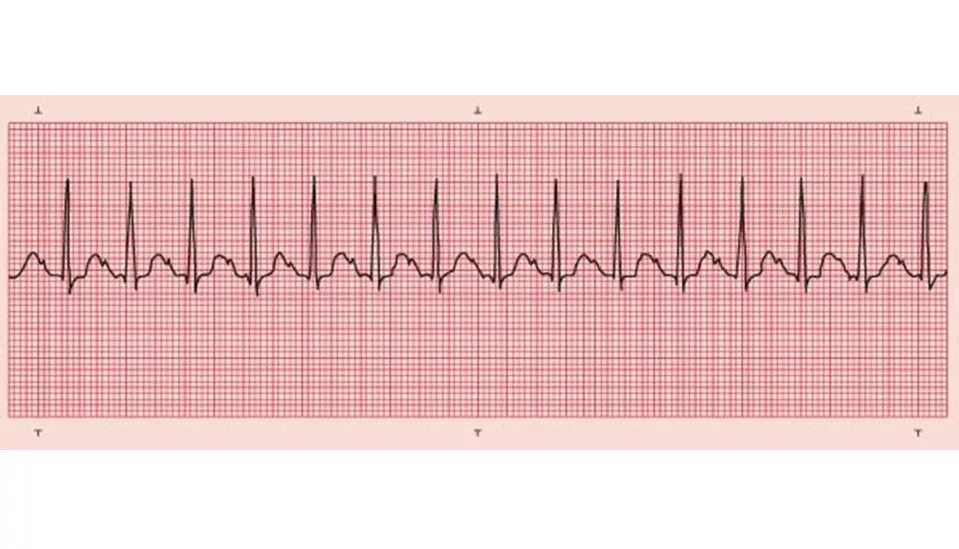 Усилилось сердцебиение. Брадикардия на ЭКГ. Сердцебиение тахикардия. Тахикардия картинки. Тахикардия схема.