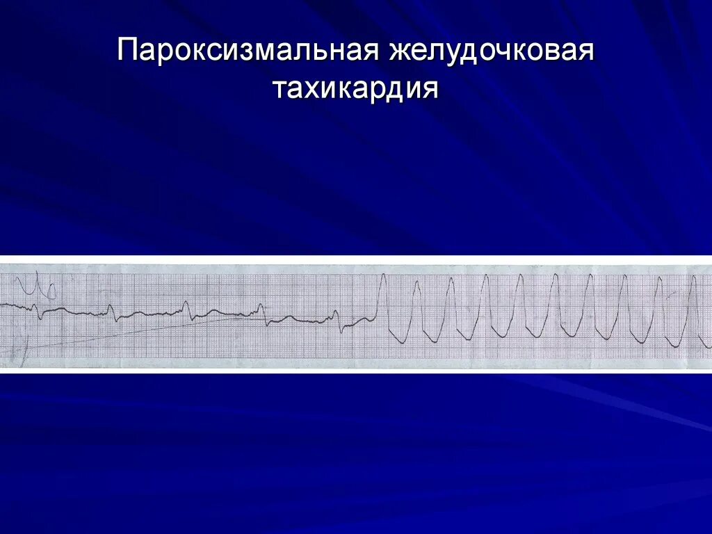 Желудочковая тахикардия на экг. Веретенообразная желудочковая тахикардия ЭКГ. Пароксизмальная желудочковая тахикардия на ЭКГ. Пароксизмальная желудочковая тахикардия ЭКГ пленка.