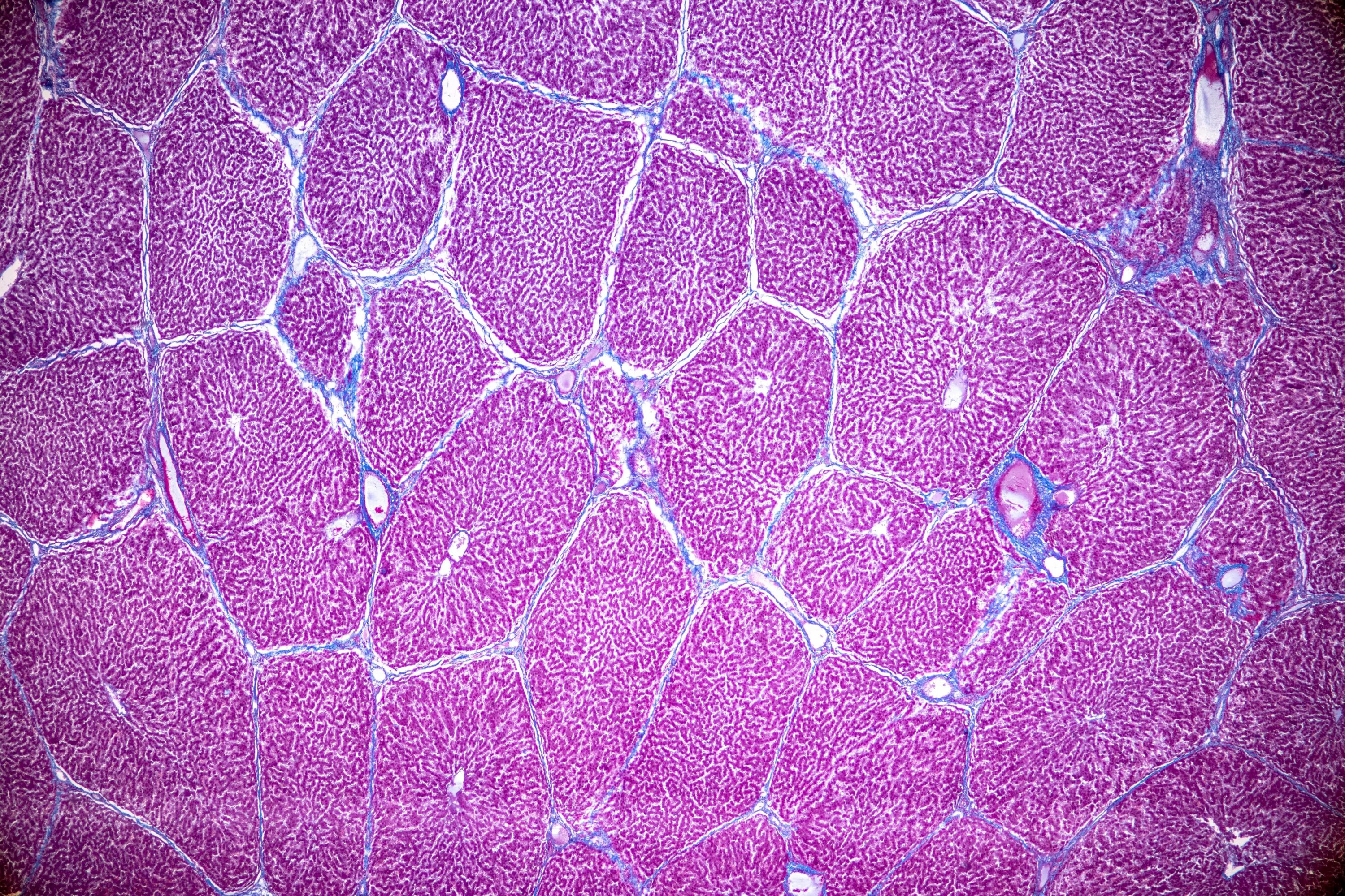 Клетки печени человека гистология. Squamous Cell carcinoma гистология. Микрофотографии гистология. Цитология гистология клетка.