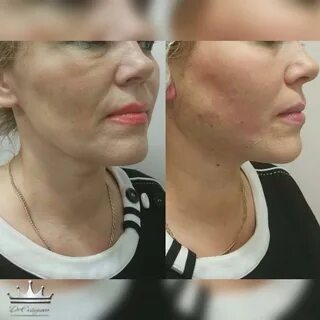 Нерассасывающиеся нити