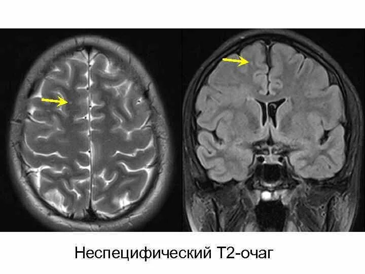 Демиелинизация головного. Очаги демиелинизации на мрт. Очаги гипомиелинизации головного мозга на мрт. Демиелинизация головного мозга мрт. Демиелинизирующее поражение головного мозга на мрт.