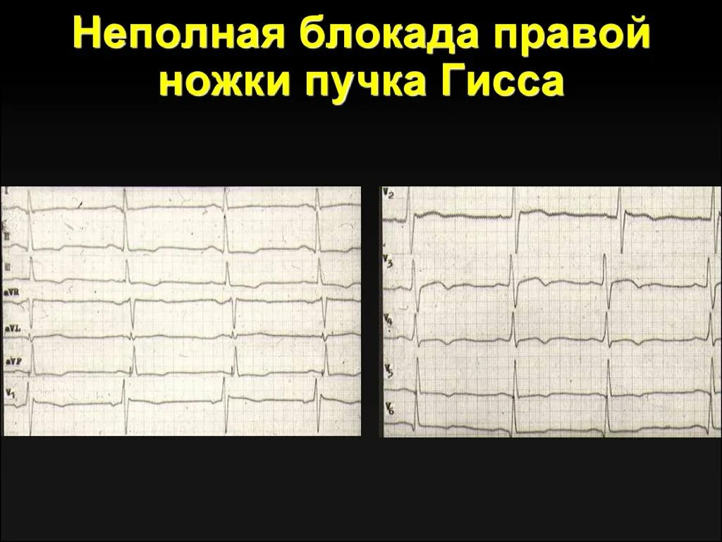 Сердце неполная блокада правой ножки гиса. Неполная блокада правой ножки пучка. Неполная блокада правой ножки. Неполная блокада правой ножки пучка Гиса. Неполная блокада правой ножки пучка с перегрузкой.