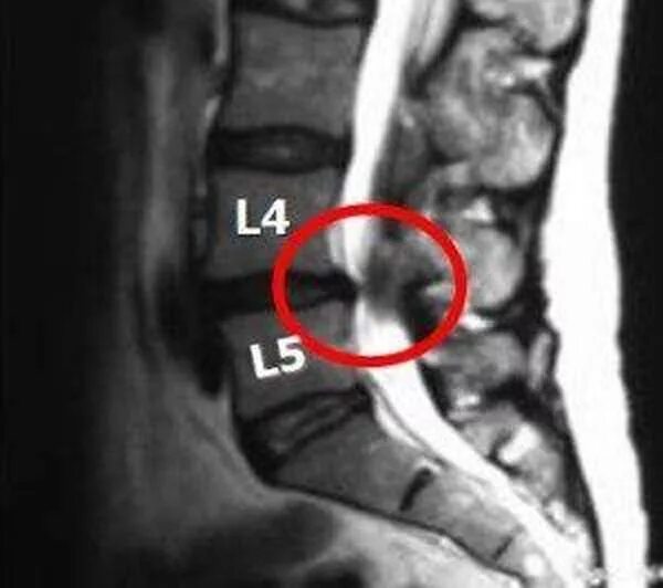 3 4 5 межпозвоночного диска. Экструзии дисков l3-s1. Экструзия диска l4-l5 что это такое. Протрузия позвонков l4 l5. Задняя Центральная экструзия диска l5-s1.