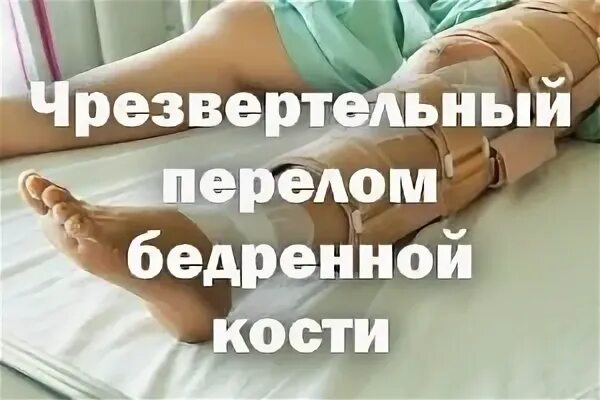Чрезвертельный перелом без операции. Чрезвертельный перелом без операции