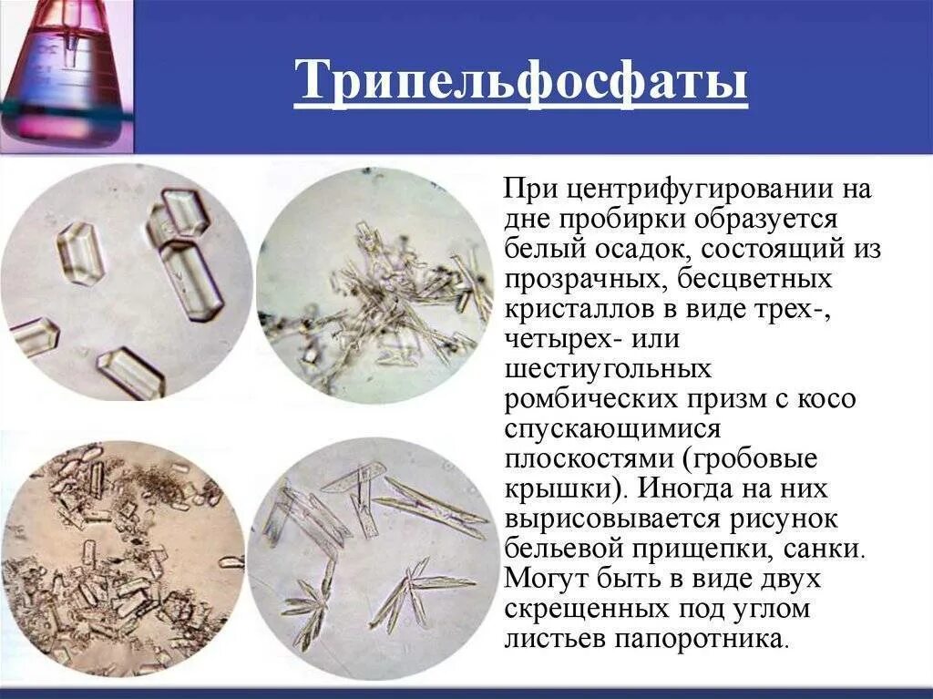 Фосфаты в моче у ребенка. Струвиты оксалаты трипельфосфаты. микроскопия мочи трипельфосфаты. микроскопия кала трипельфосфаты. микроскопия осадка мочи трипельфосфаты.