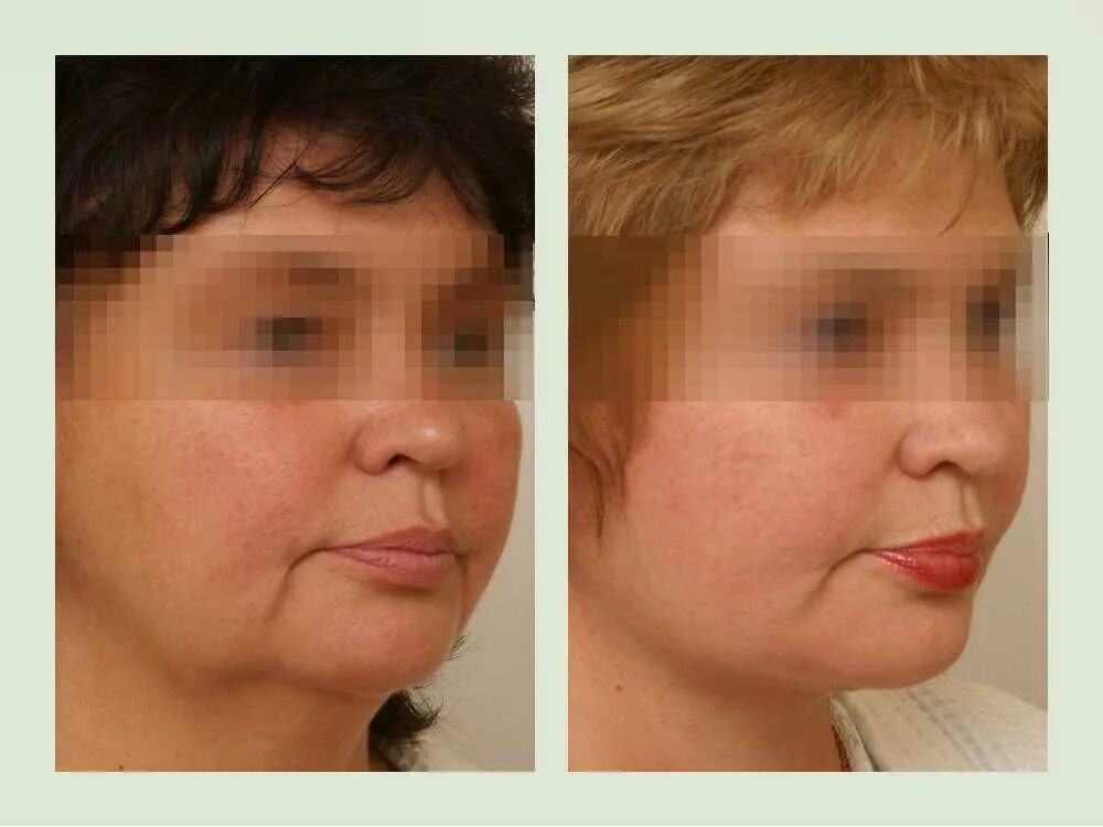 лифтинг smas платизмопластика. пластика лица смас лифтинг до и после. смас пластика лица. пластика смас подтяжка. пластика смас подтяжка.