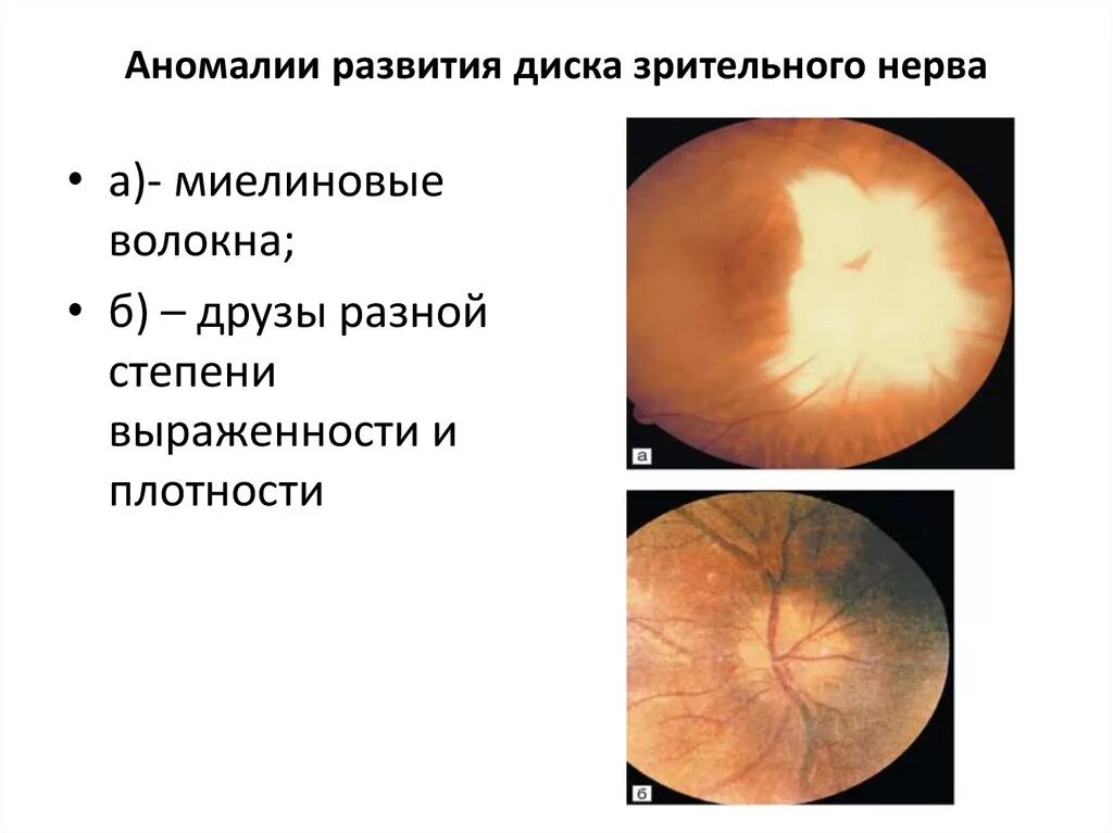 Миелиновые волокна ДЗН. Глазное дно миелиновые волокна. Патология ДЗН миелиновые волокна. Врожденные аномалии зрительного нерва.