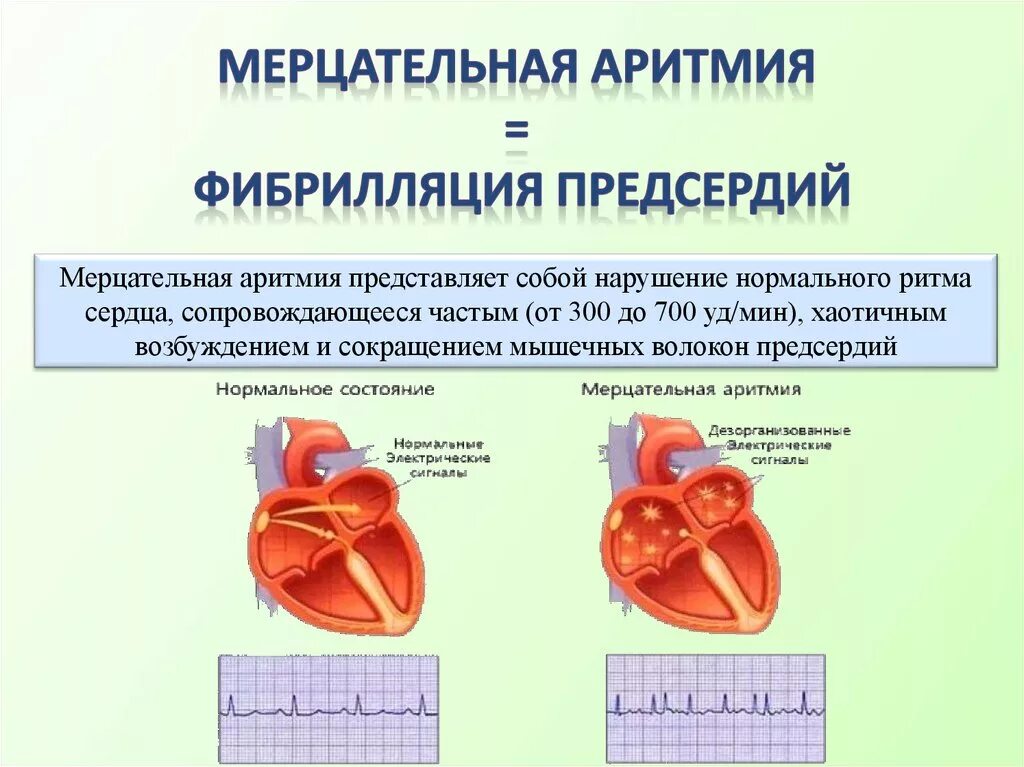 Причины мерцательной аритмии. Экг- признаками мерцательной аритмии являются:. Мерцательная артерия. Нарушение ритма фибрилляция предсердий. Мерцательная аритмия симптомы.