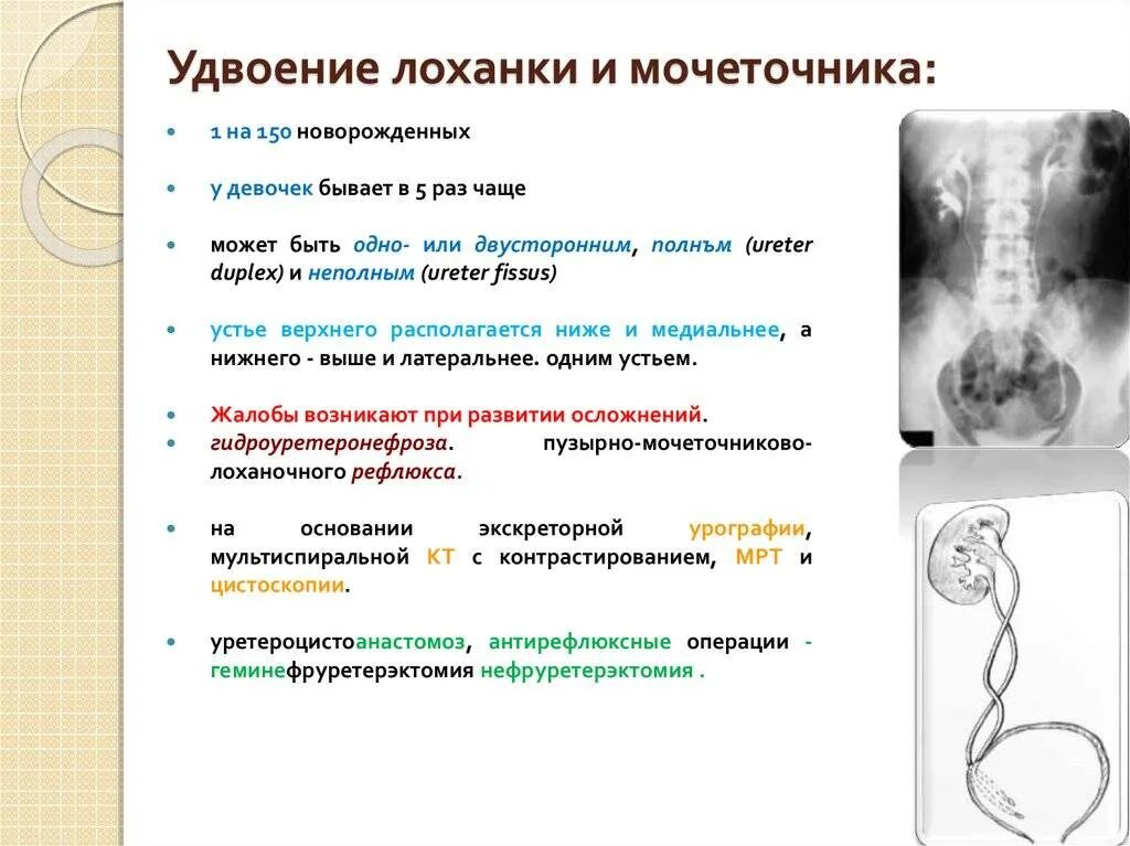 Удвоение мочеточника. Удвоение лоханки почки кт. Аномалии развития лоханок мочеточников. Аномалия удвоение мочеточника. Пороки развития почек и мочевых путей удвоение лоханки и мочеточника.