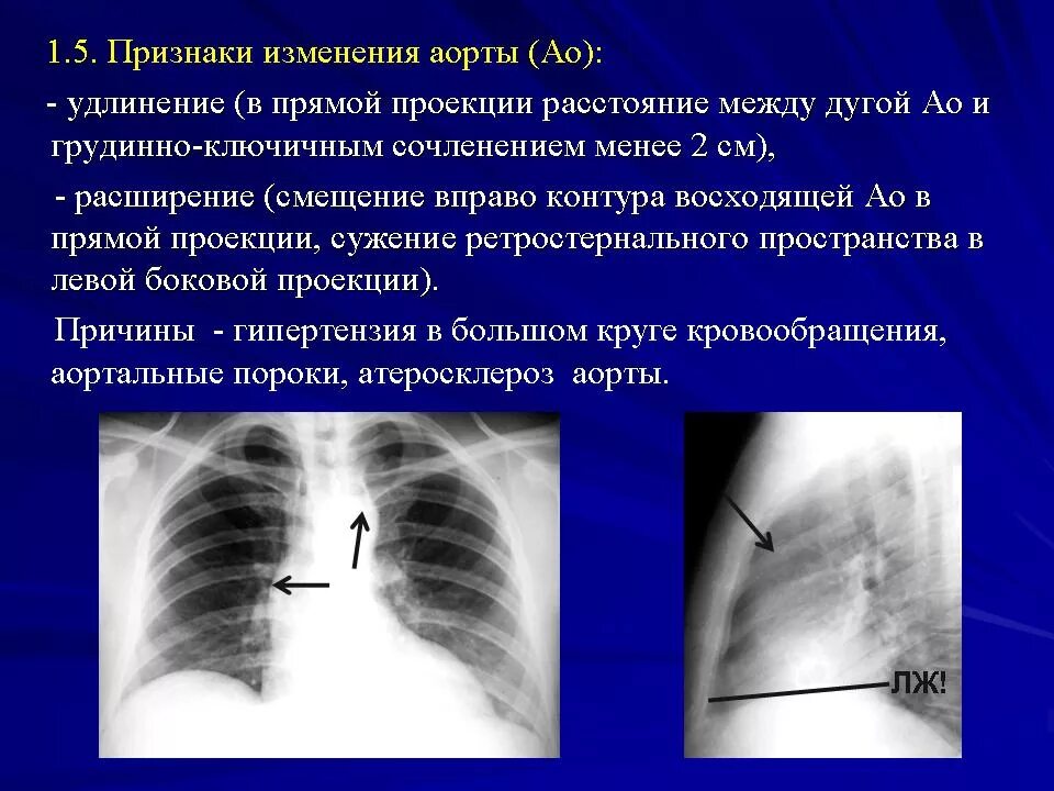 Аневризма аорты сердца на рентгене. Аневризма дуги аорты рентген. Аневризма аорты на рентгенограмме. Аневризма восходящего отдела аорты рентген. Корень легкого уплотнен что значит