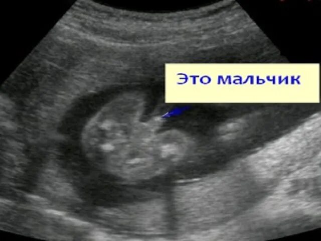 Узи 13 недель беременности мальчик. Пол по узи 13 недель. Узи плода на 14 неделе беременности пол ребенка. Пол ребенка на узи. Пол по узи 13 недель.