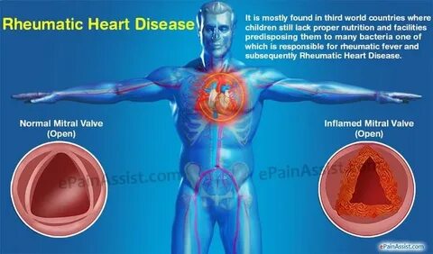 Heart disease causes