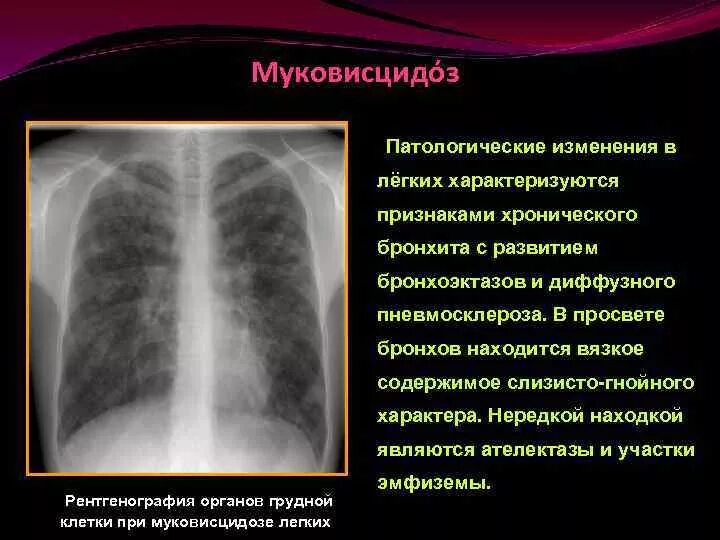 Поствоспалительные изменения в легких что это. Рентген хронический бронхит пневмосклероз. Хронический обструктивный бронхит рентген. Пневмосклероз рентген описание. Диффузный пневмосклероз рентген.