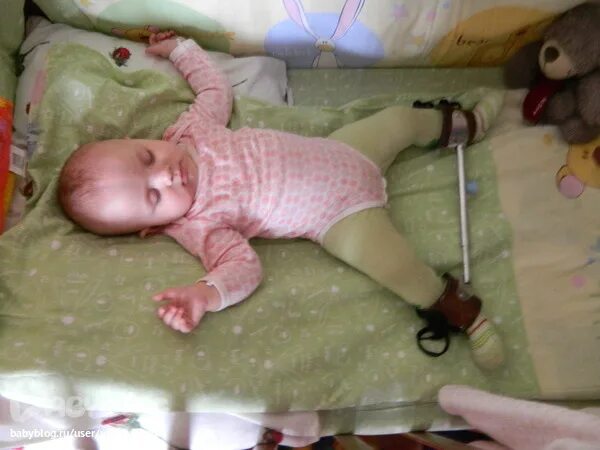 Широкое пеленание при дисплазии тбс. Виленского шина виленского. Можно ли при дисплазии. Дисплазия тбс стремена. При дисплазии тазобедренных суставов у детей в год.