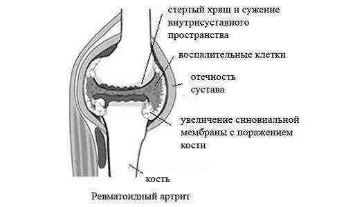 Усиленные суставы