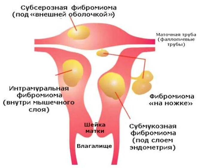 Миома матки симптомы и признаки