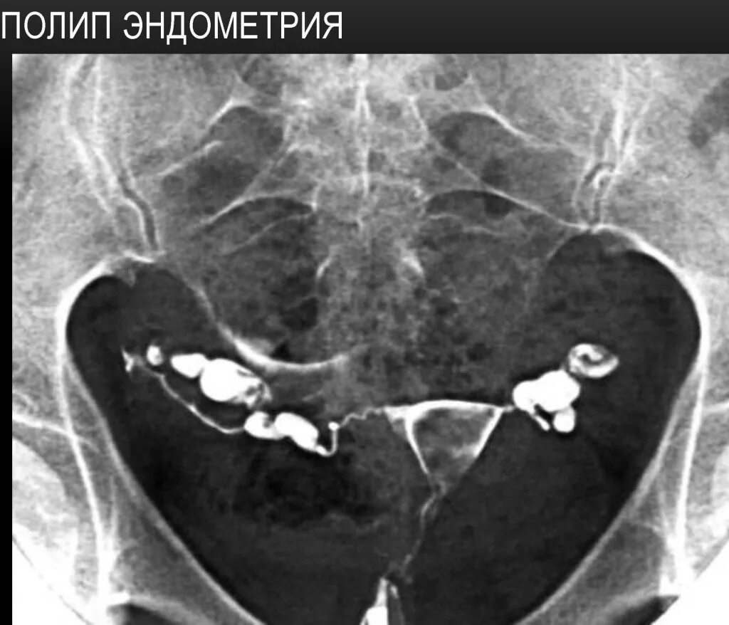 Эхо трубы. Гистеросальпингография полип. Полип матки гистеросальпингография. Гистеросальпингография маточных труб.