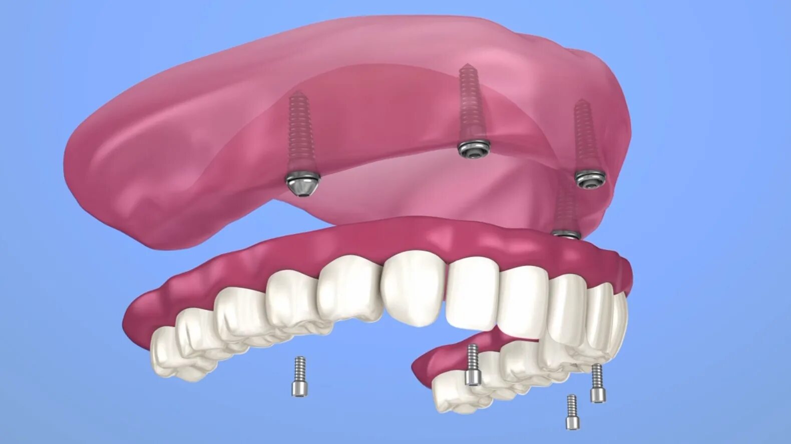 Несъемный протез на 4 имплантах.