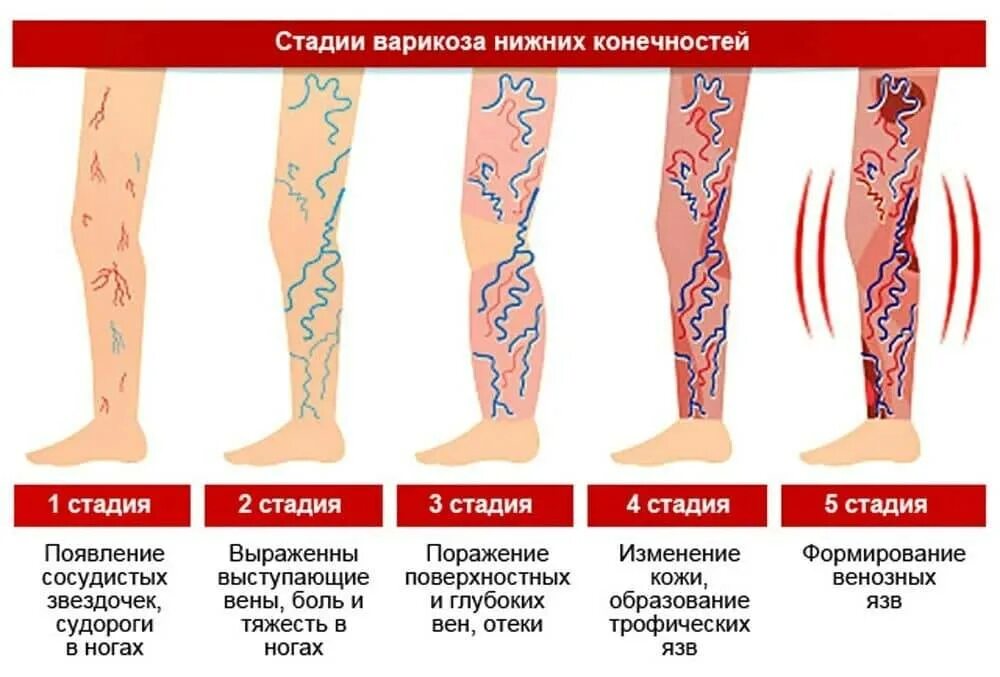 1 Стадия варикоза вен нижних конечностей. Варикозное расширение вен нижних конечностей стадии развития. Варикозное расширение вен 1 степени. Стадии клинического течения варикозного расширения вен. Диагноз расширение вен