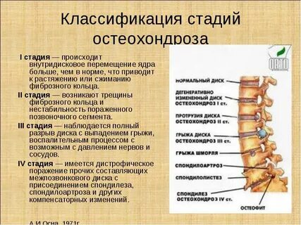 Остеохондроз шоп 1