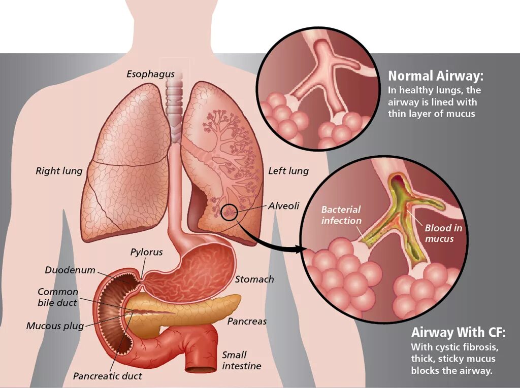 Муковисцидоз (cystic Fibrosis). Муковисцидоз легочно кишечная форма. Муковисцидоз смешанная форма. Муковисцидоз легочная форма.