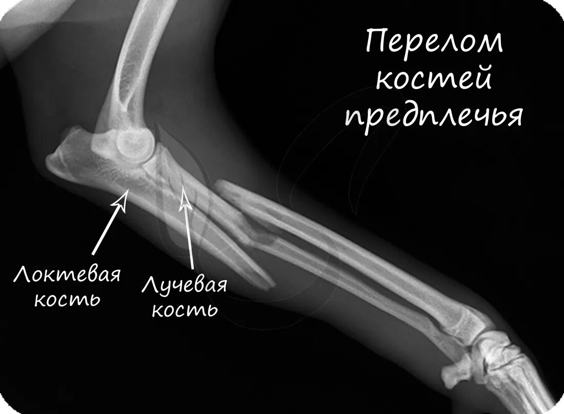 Разрыв кости. Рентгенография перелома лучевой кости. Переломы костей рентген. Рентгенограммы перелома костей предплечья.