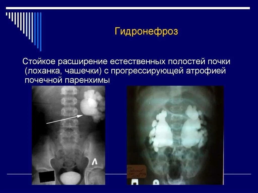 Гидронефроз правой почки (лоханка 20 мм). Расширение лоханки почки на рентгене. Симптомы расширения лоханки почки. Расширение лоханки гидронефроз.