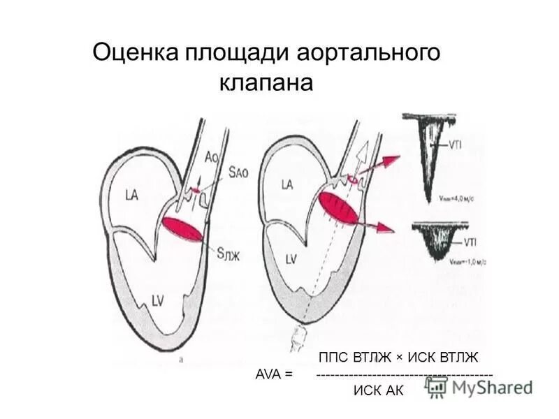 Аортальный стеноз код по мкб 10