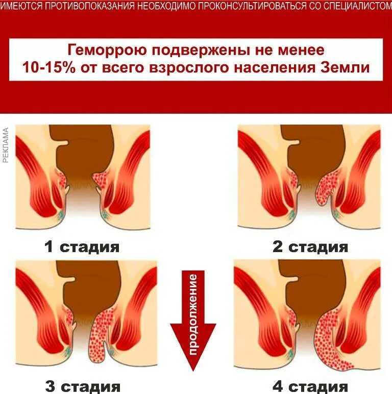 Геморрой при беременности 3 триместр что делать. Геморрой при беременности 3 триместр что делать