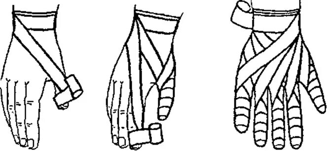 Рыцарская перчатка алгоритм. Наложение повязки Рыцарская перчатка. Рыцарская перчатка перевязка. Десмургия перчатка. 15. Наложение повязки «Рыцарская перчатка»..