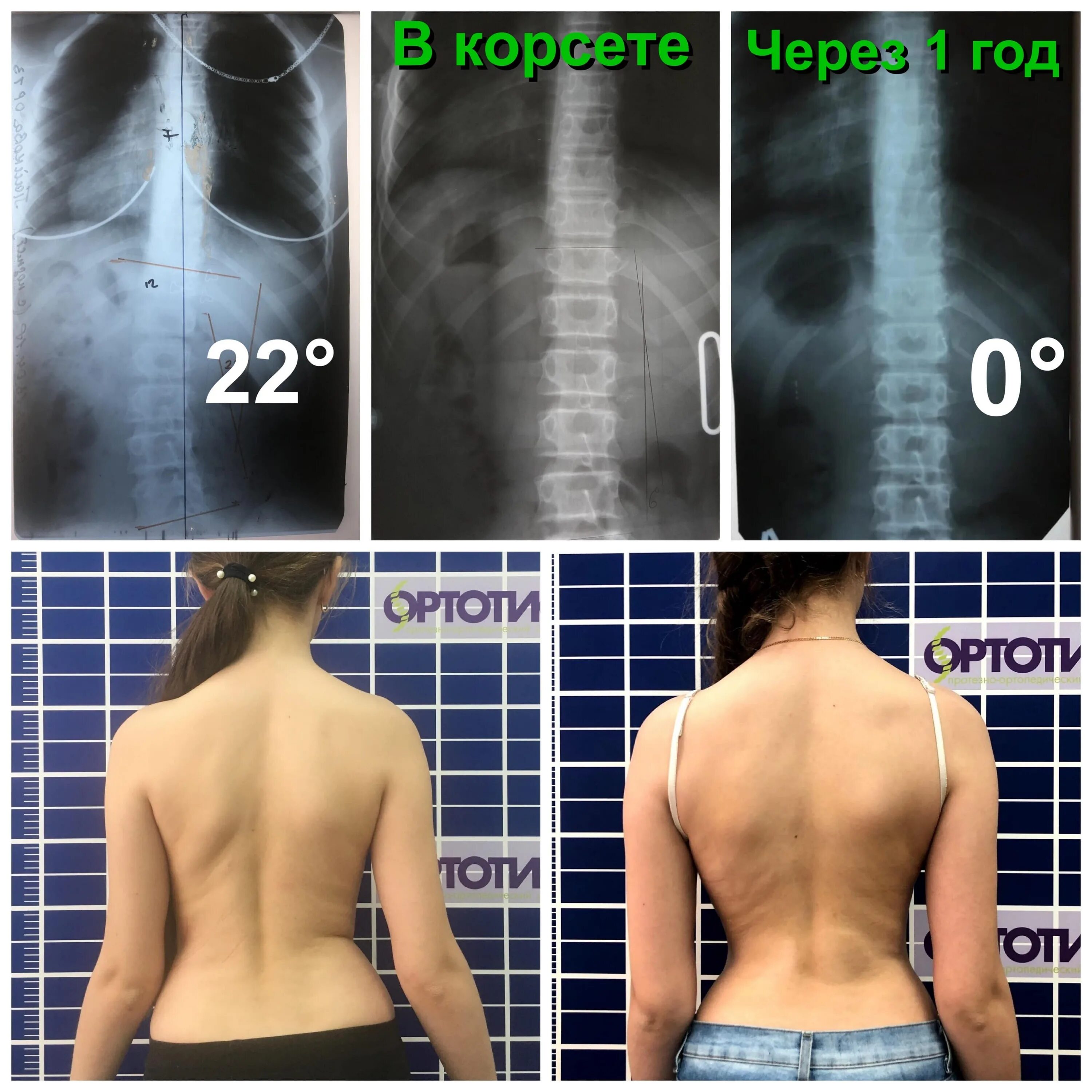 Корсет Шено Шейерман МАУ. Корсет Шено сколиоз 2 степени. Корсет Шено для Шейермана МАУ. Корсет Шено сколиоз 2-3 степени.