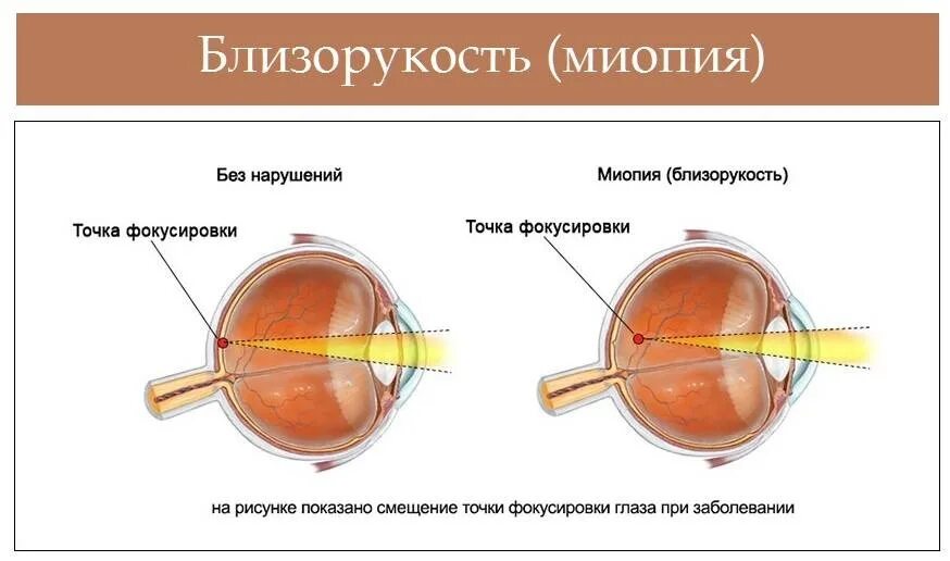 Гиперметропия средней степени глаза. Миопия средней степени астигматизм миопический. Болезнь глаз миопия. Лечится ли миопия второй степени. Диагноз зрения миопия.