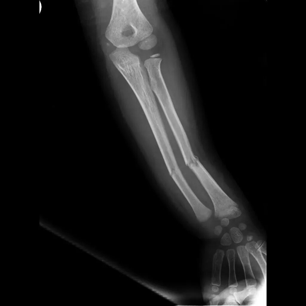 Рентген предплечья перелом локтевой кости. Перелом локтевой кости у собаки рентген. Перелом лучевой кости рентген. Рентген перелома кости предплечья.