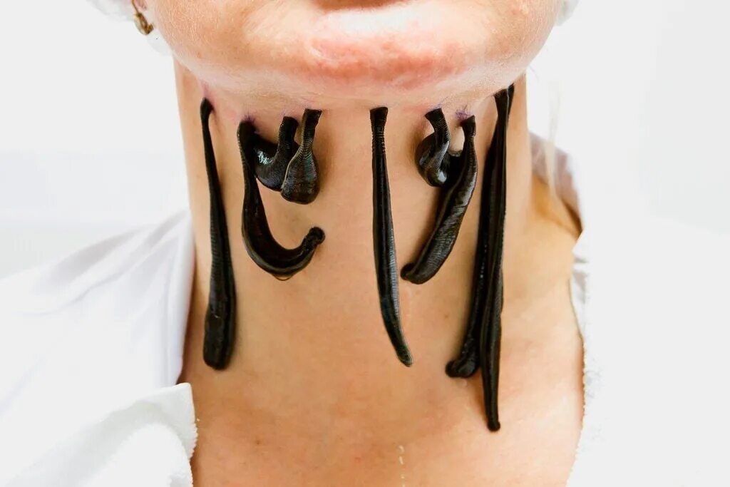 Точки постановки пиявок на лицо. Гирудотерапия в косметологии. Лицо куда ставят пиявок. Лицо куда ставят пиявок. Лицо куда ставят пиявок.