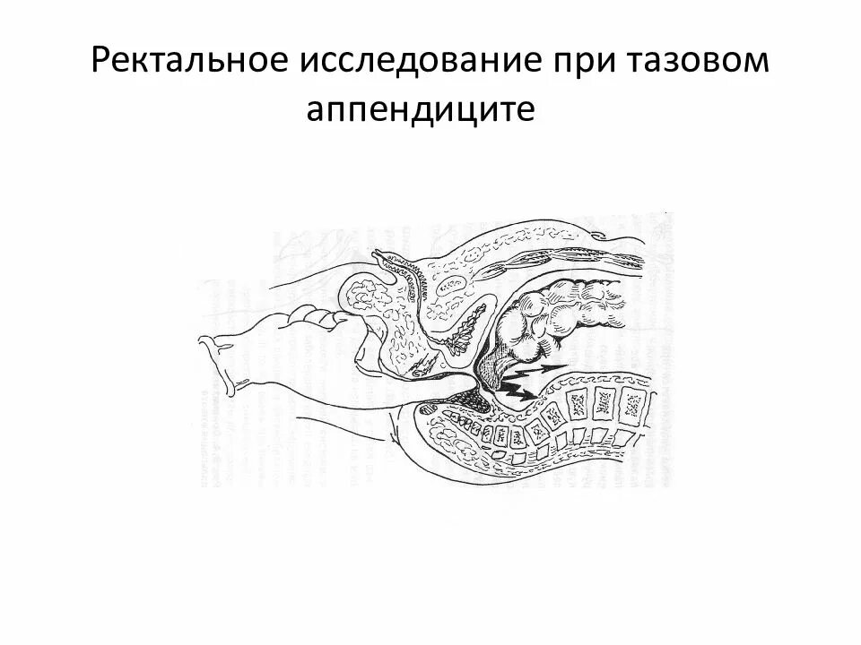 Ректальные железы. Ректальное исследование при аппендиците. Пальцевое ректальное исследование при аппендиците. Ректальное инструментальное исследование. Атипичные формы острого аппендицита.